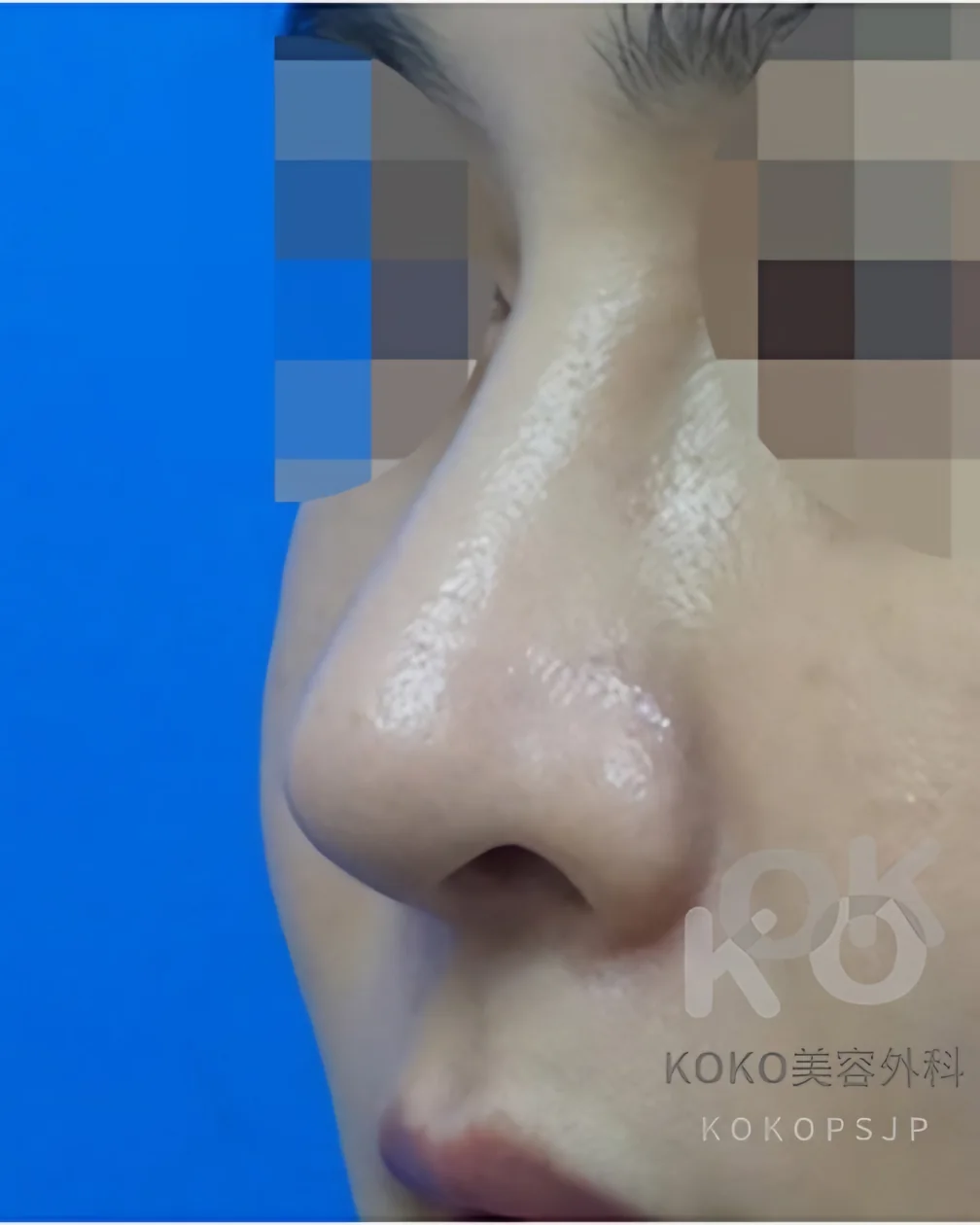 Bulbous nose, 45° view, after surgery