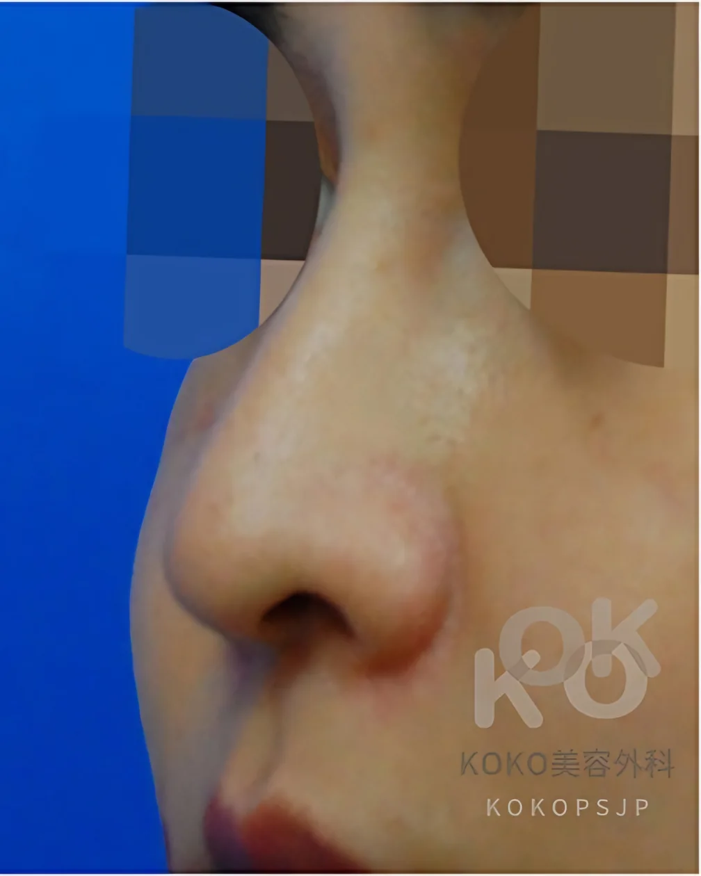 Bulbous nose, 45° view, before surgery