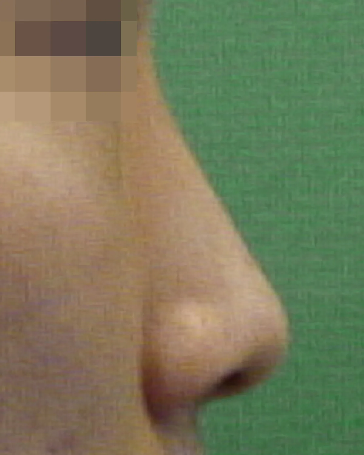 男性・横顔の手術前