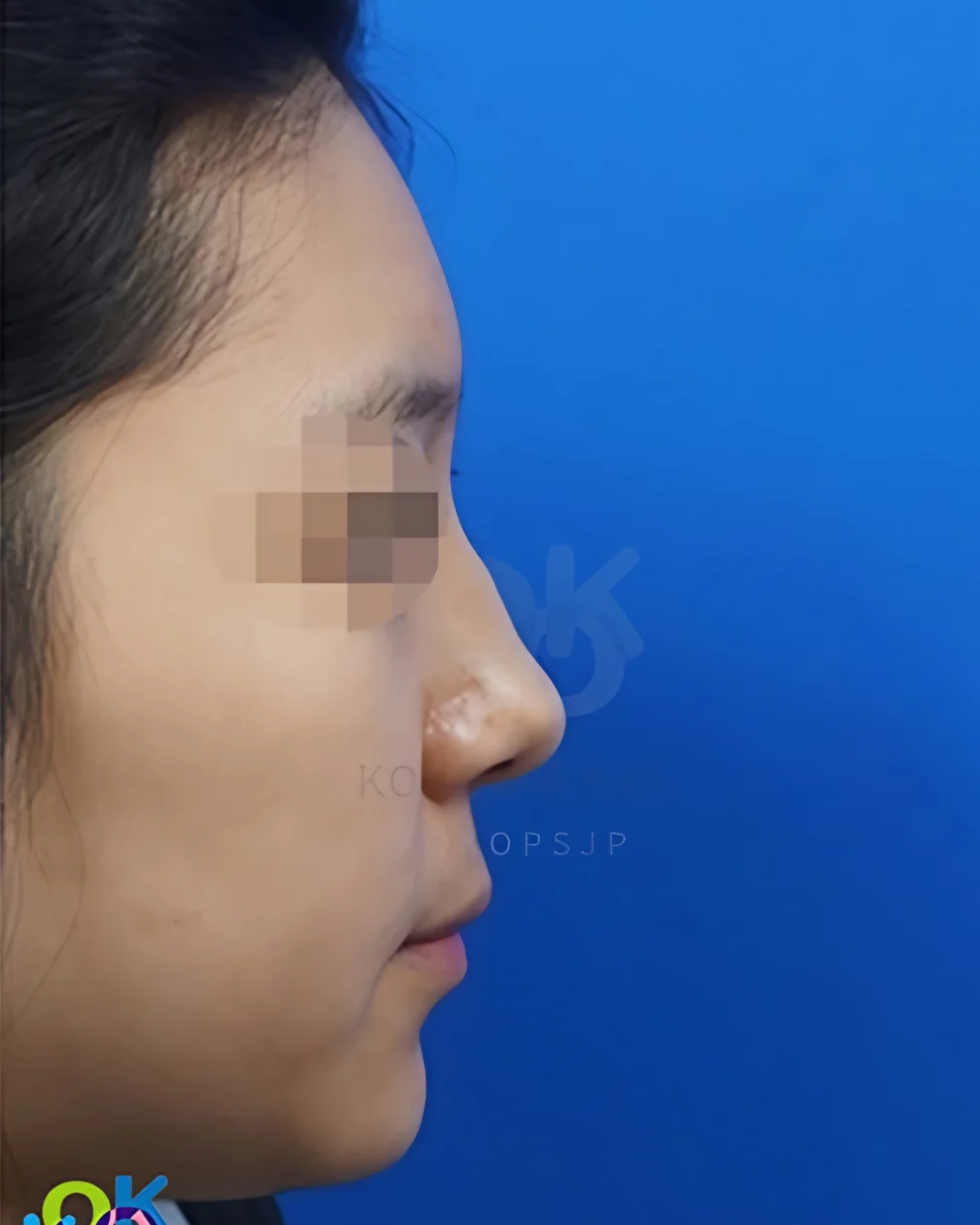 Low nose, side view, before surgery