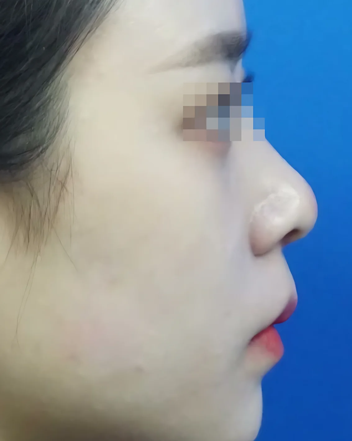 Upturned nose, side view, after surgery
