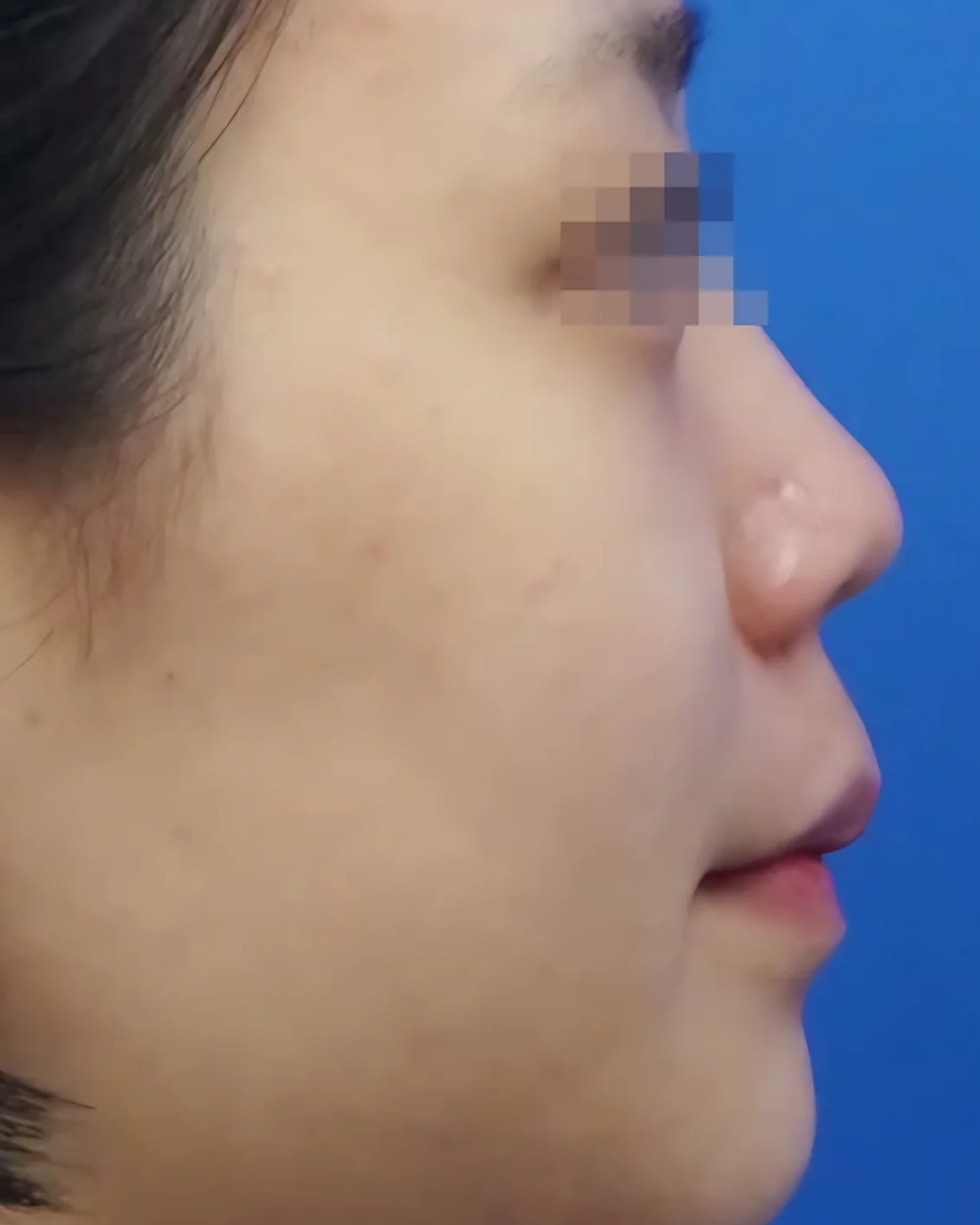 Upturned nose, side view, before surgery