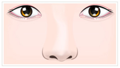 KOKO美容外科での曲がった鼻を正面から見た状態を現した画像。