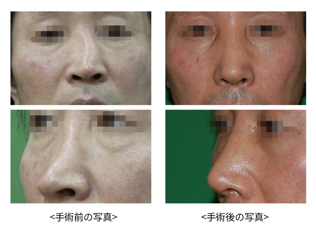 KOKO美容外科での曲がった鼻の症例写真。左側が手術前の正面と横向きの写真、右側が術後まっすぐになった正面と横向きの写真