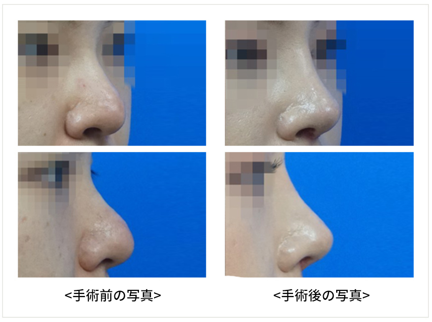 KOKO美容外科で団子鼻の鼻整形を受けた症例写真。左側が手術前、右側が手術後の写真