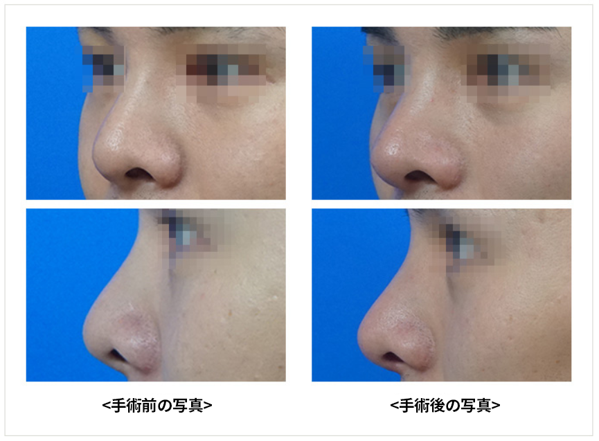 KOKO美容外科での男性の鼻整形の症例写真。左側が手術前、右側が手術後の斜めからと真横から見た様子