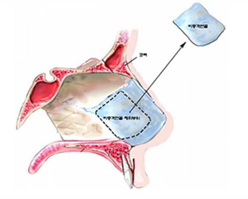 韓国の鼻整形で多く使用される鼻中隔軟骨の使用例と鼻中隔軟骨の簡単な説明画像