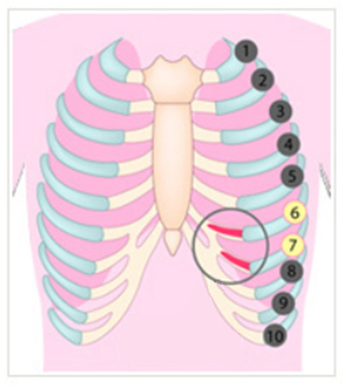 韓国での鼻整形で多く使用される肋軟骨の採取位置の説明図。胸の下にある肋軟骨を使用する。