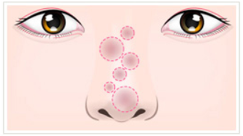 鼻の整形で鼻に炎症が起きてしまった状態を上面から現した図