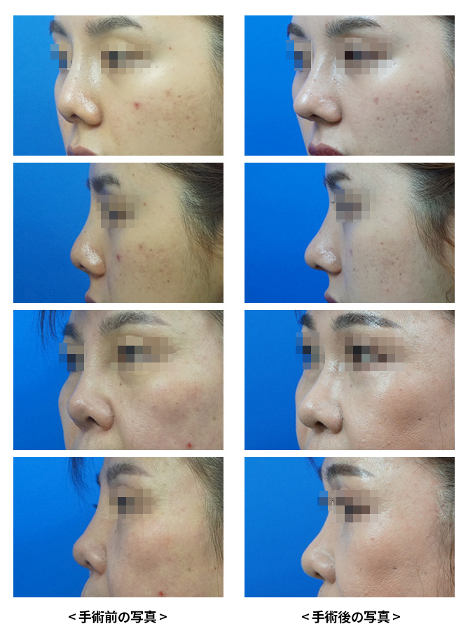 KOKO美容外科で鼻の再手術を受けた女性の症例写真。4人の患者さんの写真があり左側に手術前、右側に手術後の写真がある