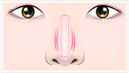 鼻の整形でプロテーゼが固定されず動いてしまった状態を正面から見た図
