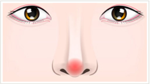 鼻の整形で皮膚が薄くなり鼻先が赤くなってしまった状態を正面から見た図
