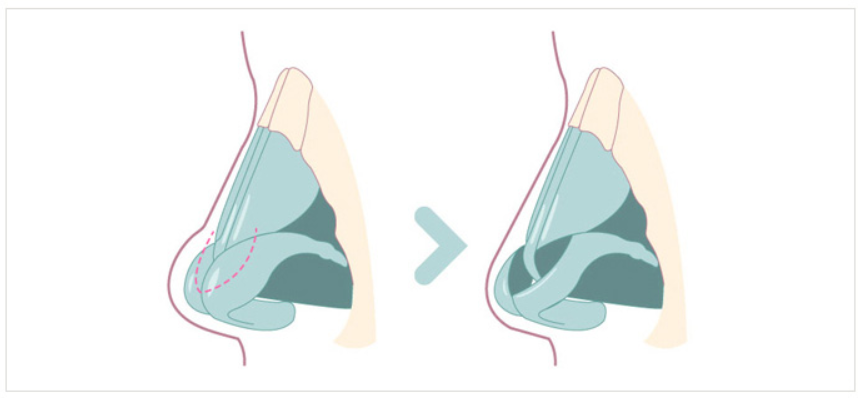 KOKO美容外科での鼻先整形を横から見た手術前と主手術後の画像。左側手術前、右側手術後