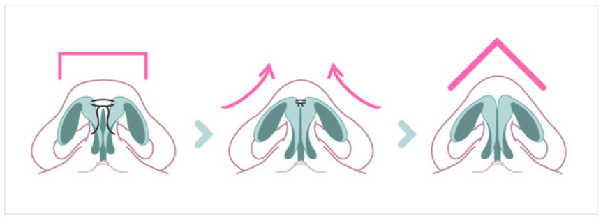 KOKO美容外科での軟骨除去術を用いた鼻先整形の手順を説明した図。
