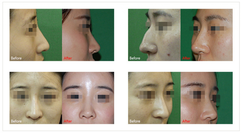 KOKO美容外科での鷲鼻の手術の症例写真。上2枚は横から見た手術前と術後の写真、下2枚は正面から見た写真。