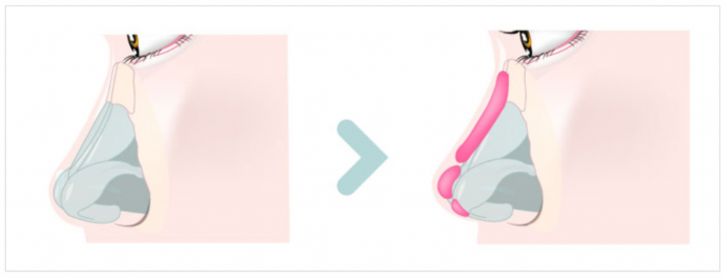 KOKO美容外科での鼻手術の方法を絵で説明。左側は手術前、右側はプロテーゼや肋軟骨を入れた後、高くなった状態を現した画像