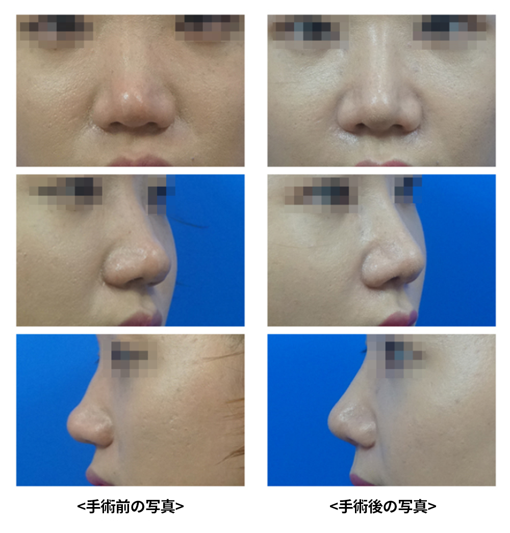 KOKO美容外科での低い鼻整形の症例写真。左側が手術前、右側は手術後。上から正面、斜め、横向きの写真