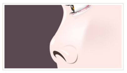 KOKO美容外科での短い鼻を横から見た図。鼻先が上がって全体的に短い印象。
