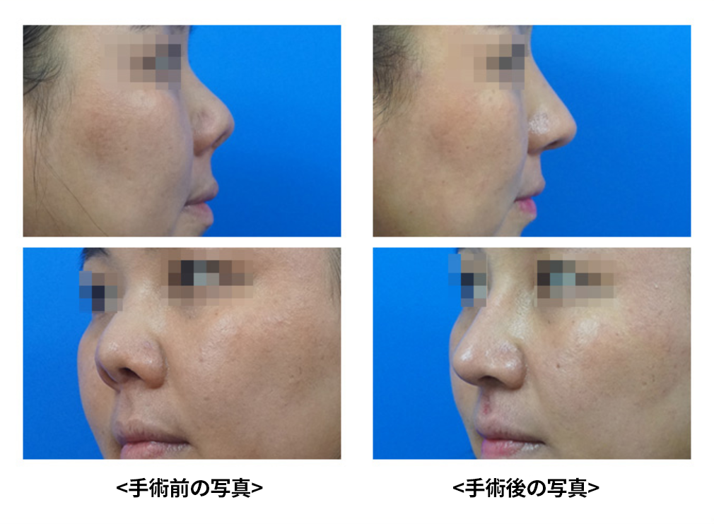 KOKO美容外科での短い鼻整形の症例写真。左側が手術前、右側が手術後。