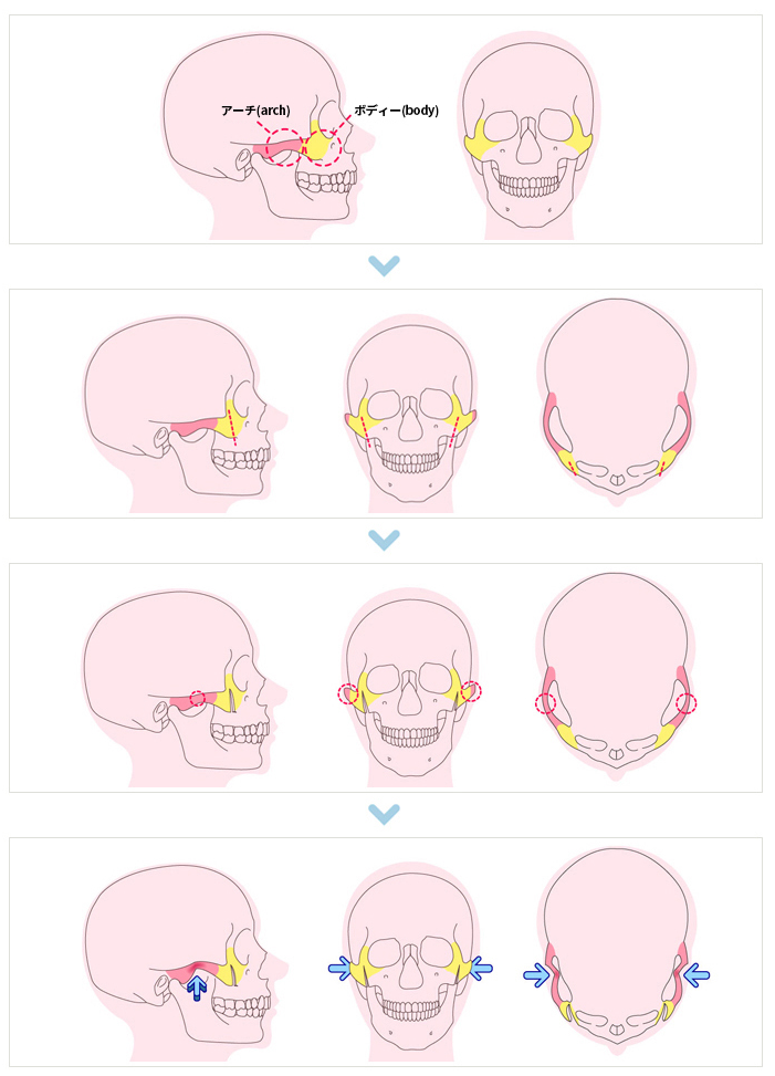 ココ美容外科の頬骨整形課程です。 手術がどのように行われるのか、どのように改善されるのか確認してみてください。