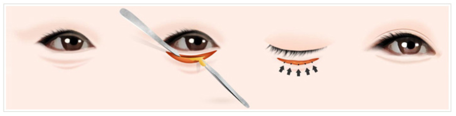 下眼瞼整形の過程です。 部位を確認した後、目の下の脂肪を確認し、適切に再配置/除去する手術です。
