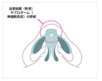 KOKO美容外科での鼻先の自家組織とアロダームを使用した隆鼻術を現した図