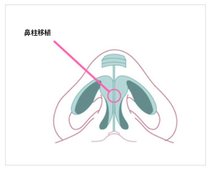 KOKO美容外科での鼻先の鼻柱移植での隆鼻術を現した図