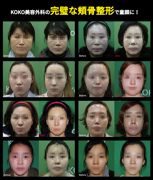 ココ美容外科の頬骨整形を受けた方の事例写真です。 どれだけ、どのように変化があるのか直接確認してみてください。