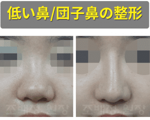 韓国ココ美容外科の低い鼻、団子鼻整形前後の正面写真です。 左の写真は鼻が全体的に丸く低い形をしています。 右側の成形後の写真には鼻の形が鮮明に表れていて、シャープな形をしています。