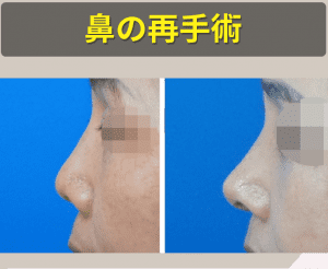 韓国ココ美容外科で鼻再手術を受け、変わった横顔です。 左側に手術を受ける前の写真の鼻は低く、凝った姿ですが、手術後の右側の写真での鼻はふっくらとして鼻先の形を整えています。