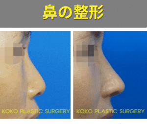 ココ美容外科の低鼻整形前後の側面写真です。側面から確認したところは、鼻の高低がはっきりしていることがわかります。 左側は鼻が口と似た大きさを持っていますが、右側の写真は鼻が大きくなって顔の屈曲が確実に見えて変わった部分を確認できます。