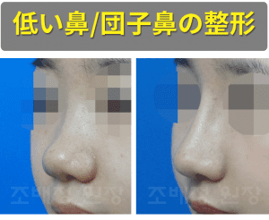 韓国ココ美容外科の低い鼻、団子鼻整形前後の正面45度の写真です。左は手術前の写真で、団子鼻の形を見せています。 鼻先が上を向いていて、鼻の穴が見える形をしています。 右側は手術後の写真で、鼻がまっすぐ立っていて、鼻先の形も硬くなくシャープな形をしています。