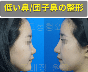 韓国ココ美容外科の低い鼻、団子鼻整形前後の側面写真です。左は手術前の写真で、団子鼻の形を見せています。 鼻先が上を向いていて、鼻の穴が見える形をしています。 右側は手術後の写真で、鼻先が下を向いていて、鼻の形も全体的に大きくなっている状態です。