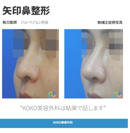 KOKO美容外科、韓国矢印鼻の手術方法・症例写真