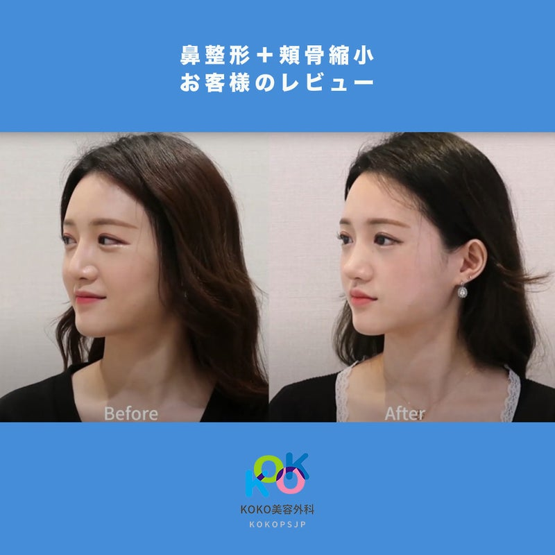 狎鴎亭KOKO美容外科の鼻手術＆韓国頬骨縮小手術レビュー