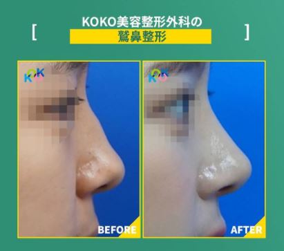 韓国鼻整形専門病院KOKO美容外科-鷲鼻矯正手術の方法と症例