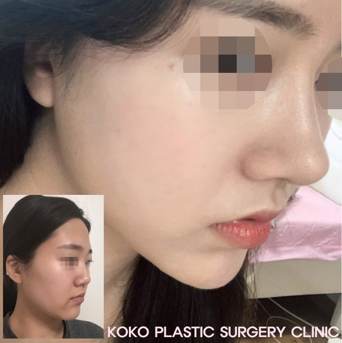 鼻手術＆再手術専門のKOKO美容外科－韓国鼻の手術 悩むのはもうやめましょう