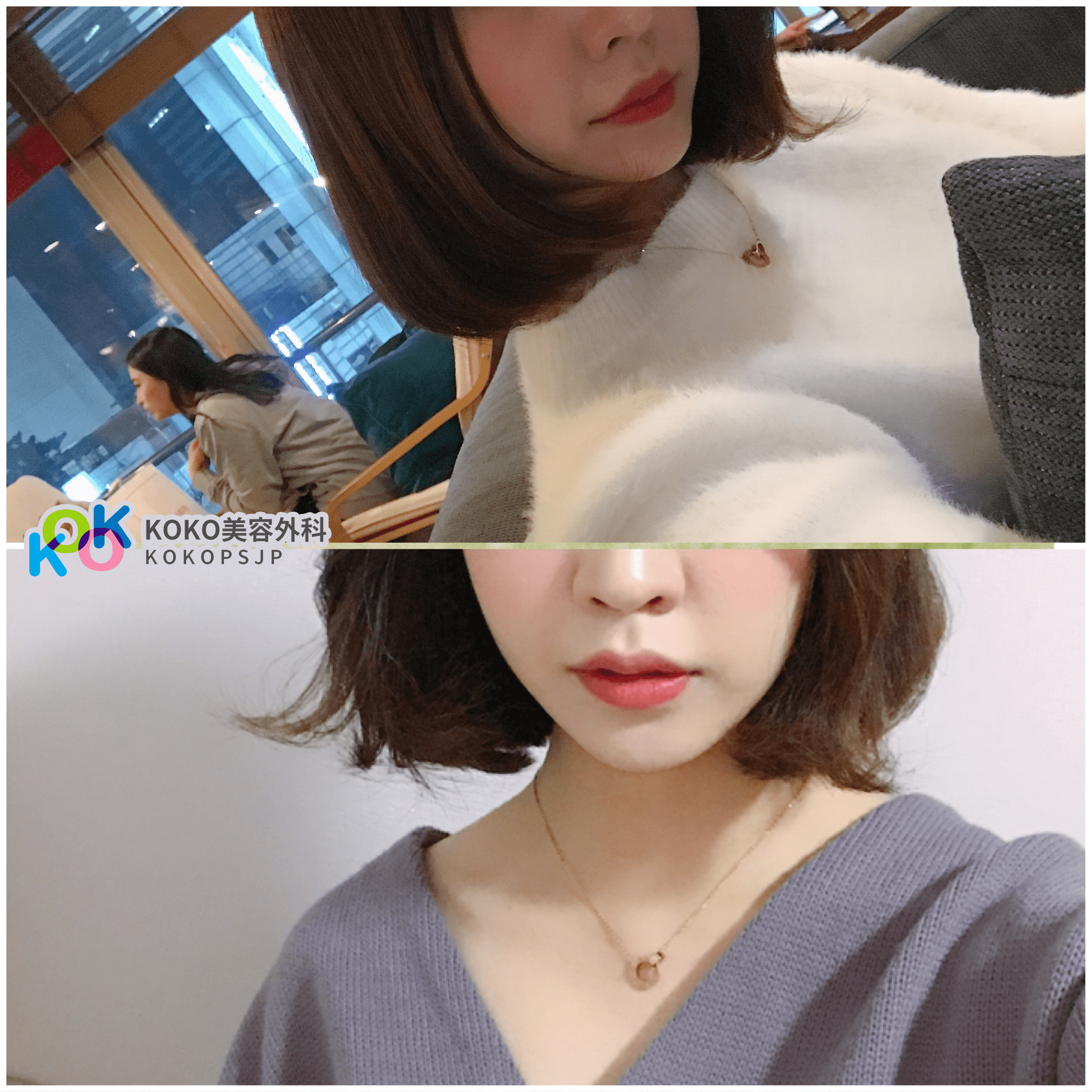  | Korea's Top Nose Revision Specialist