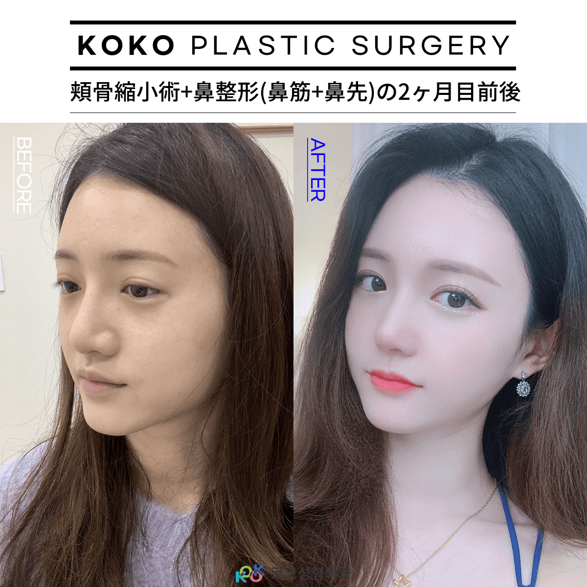 01 | Korea's Top Nose Revision Specialist | Korea's Top Nose Revision Specialist