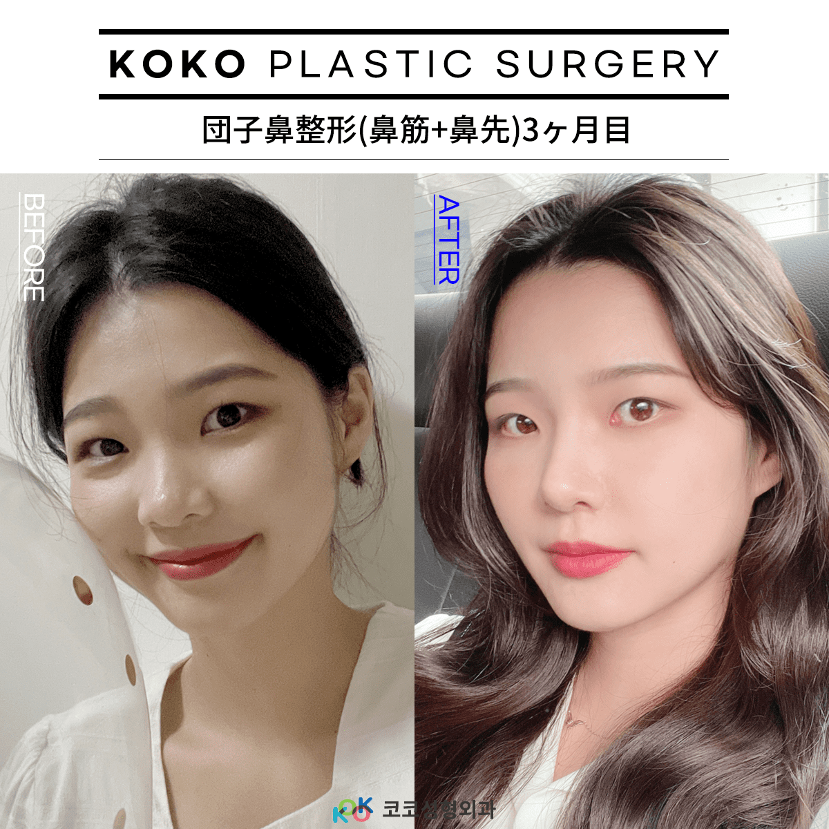 02 | Korea's Top Nose Revision Specialist | Korea's Top Nose Revision Specialist