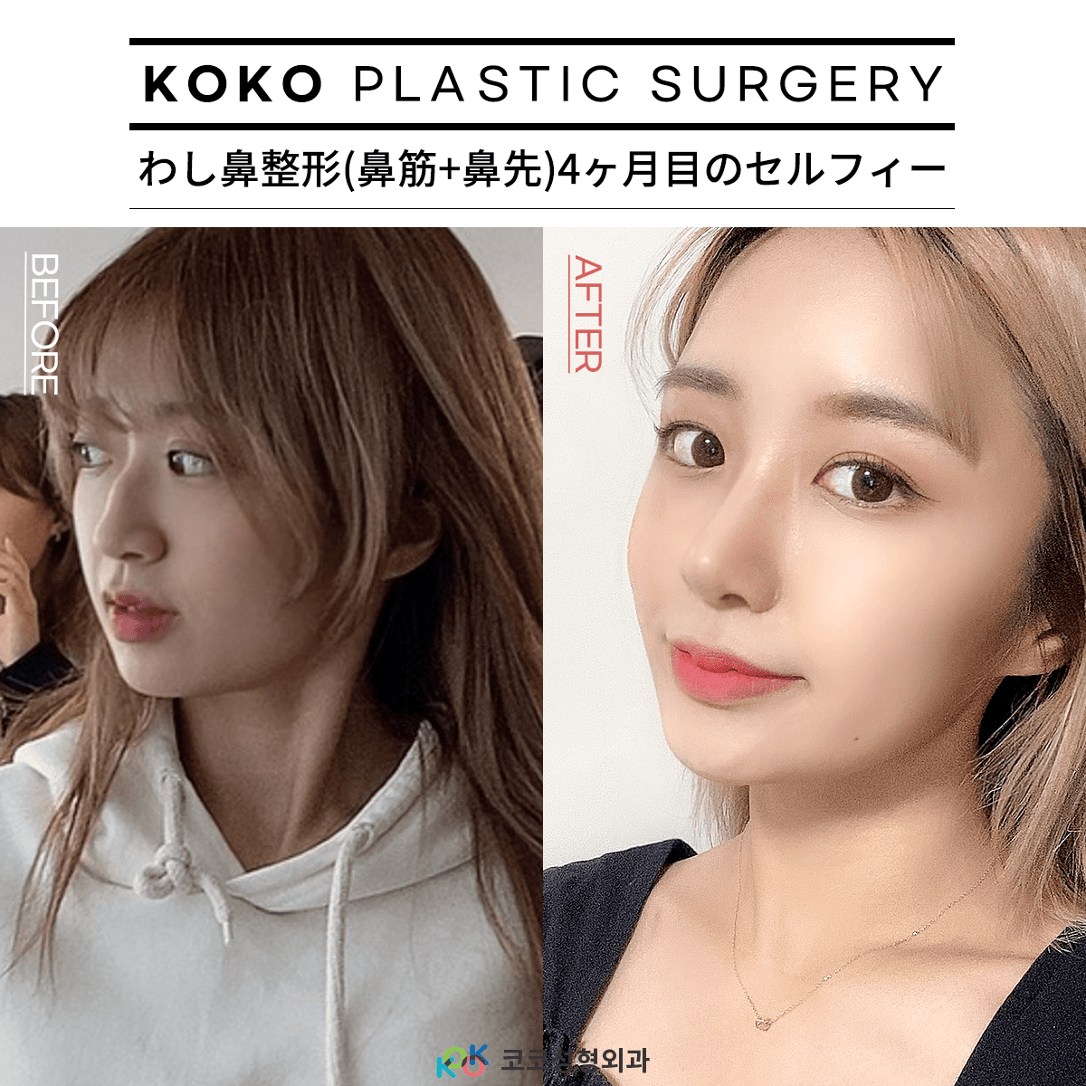 4____ 복사 | Korea's Top Nose Revision Specialist | Korea's Top Nose Revision Specialist