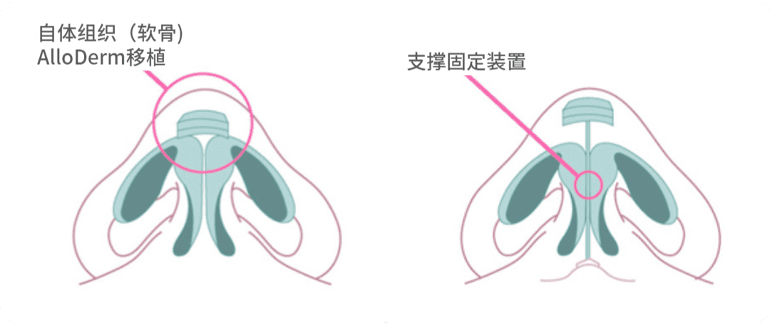  | Korea's Top Nose Revision Specialist