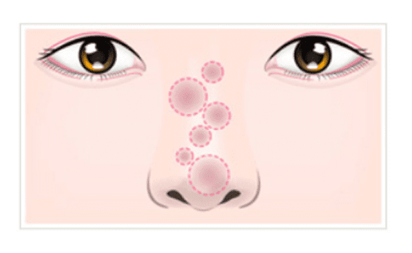 鼻の整形での副作用が出てしまった方の改善法などをご紹介したブログ内での炎症を現した画像