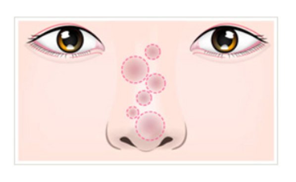 鼻の美容整形で副作用が起きてしまった時の症例。赤みがでたりする状態