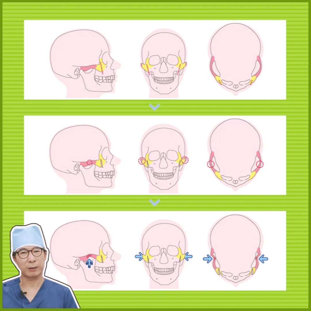 A picture explaining the process of cheekbone reduction