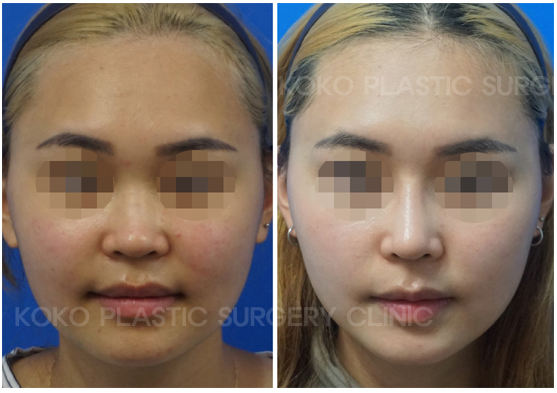  | Korea's Top Nose Revision Specialist