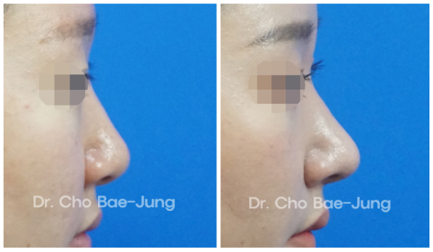  | Korea's Top Nose Revision Specialist