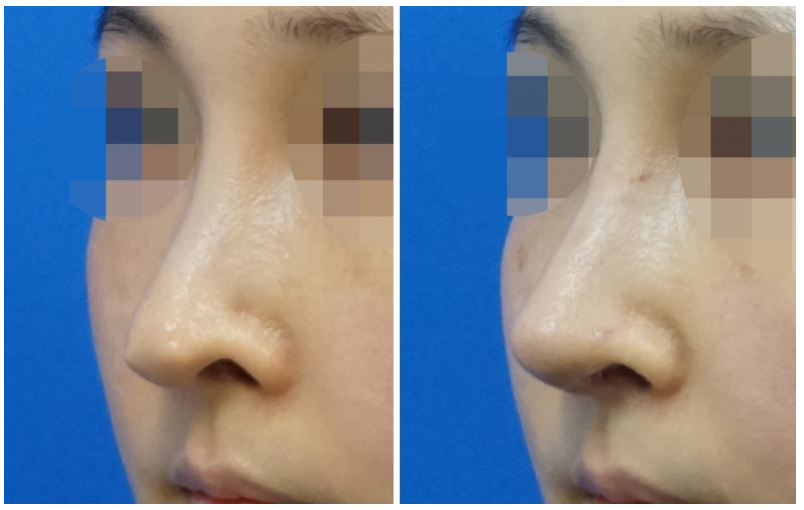  | Korea's Top Nose Revision Specialist