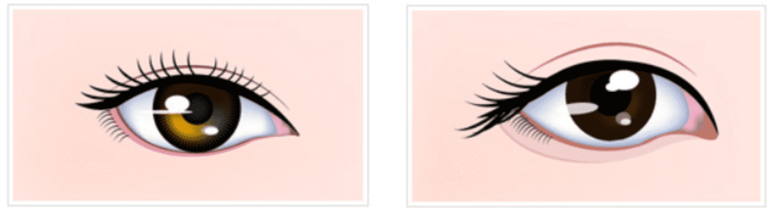KOKO美容外科での目の整形のイメージ画像。猫目や犬の目の画像