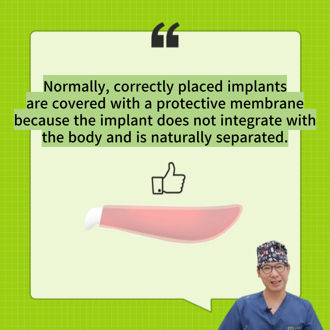 rhinoplasty with implants
